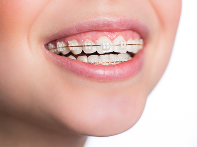 保険適用の矯正治療