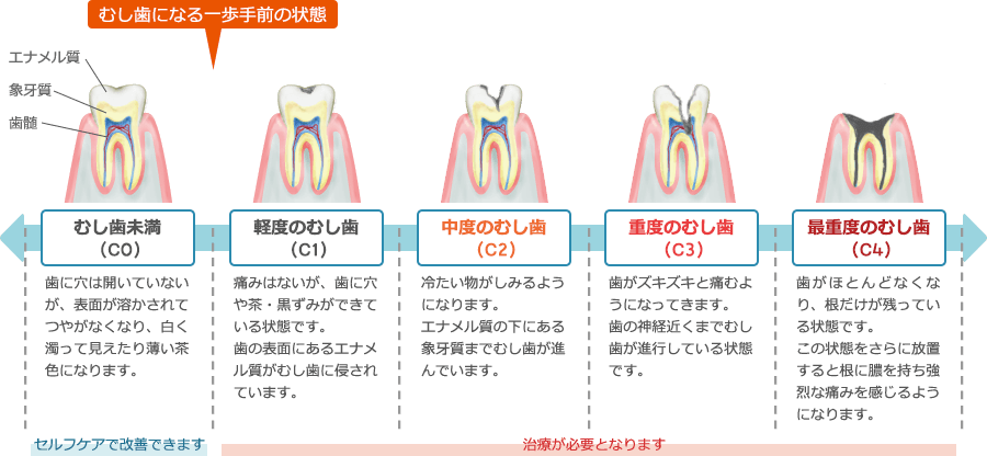 むし歯はどんどん進行します