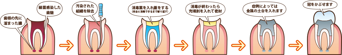 歯の神経までむし歯が及んだら